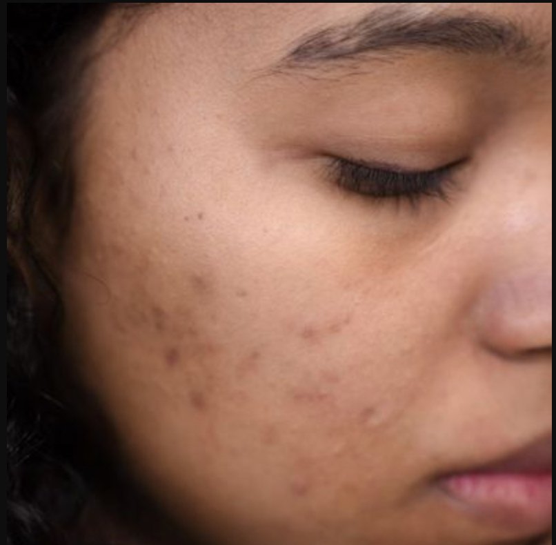 Let's Talk About How To Treat Acne - ORESTA mindful beauty