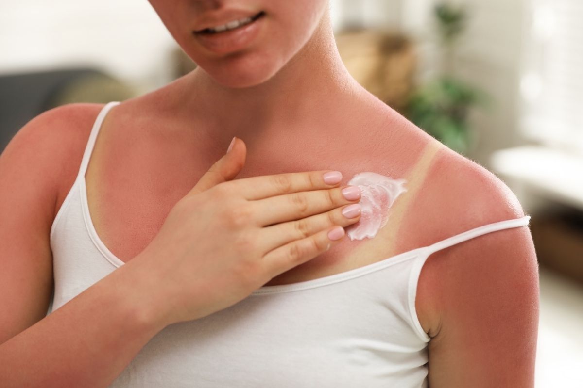 Spring Sunburn? Here's How to Help Your Skin Recover - ORESTA mindful beauty