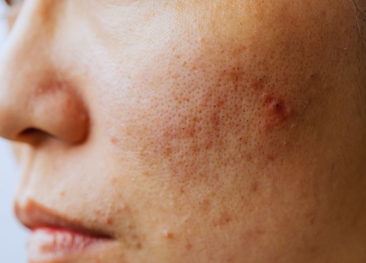 Understanding Acne: A Holistic Approach to Acne-Prone Skin - ORESTA mindful beauty